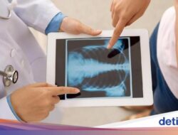 Hari Radiografi Sedunia 8 November, Peringati Penemuan Sinar-X